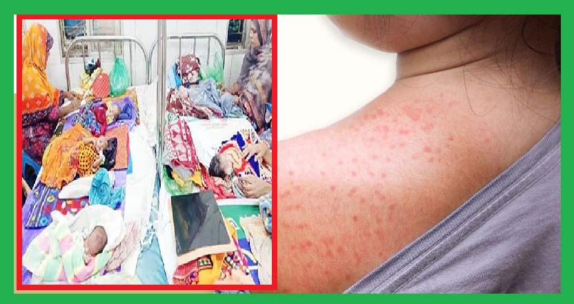 সারাদেশে হাম সংক্রমণ বেহাল দশা ঢাকায়